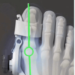 Corector pentru Monturi MONTFIX™!